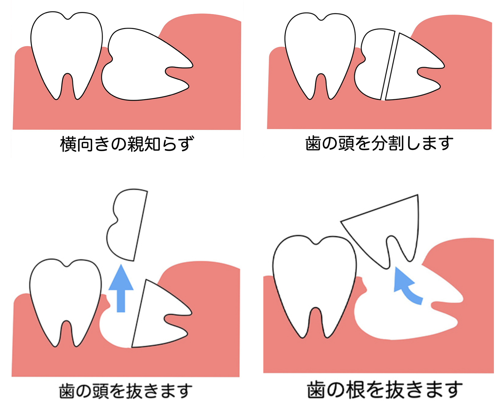 親知らずの抜歯や抜歯後について 痛みや腫れのピーク 食事はできる!? 藤沢の歯医者|藤沢ギフト歯科・矯正歯科 親知らずの抜歯や抜歯後について 痛みや腫れのピーク 食事はできる!? 藤沢の歯医者|藤沢ギフト歯科・矯正歯科